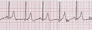 Ekg Tracing Ekg Tracing